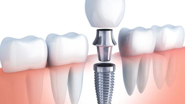 implantologia in zona molare