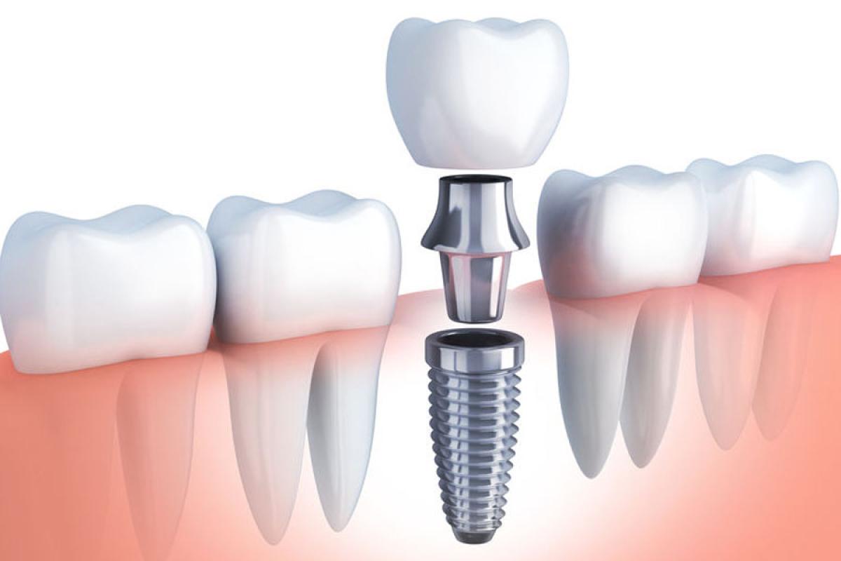 Implantologia nella zona molare